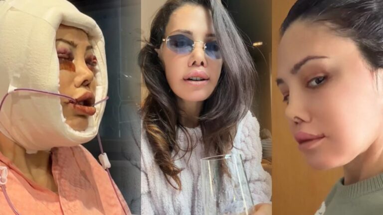Kore’de yüz nakli yaptırmıştı! Didem Ceran bir kez daha bıçak altına yattı! Son haline kimse dayanamadı